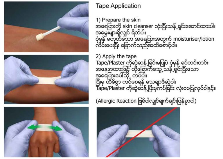 MARSI (Medical Adhesive Related Skin Injuries ကော်ကပ်ခြင်းကြောင့် ဖြစ